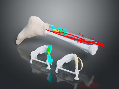 3D Bone Model With Implant Components Red Lines And Surgical Support Devices 3d model