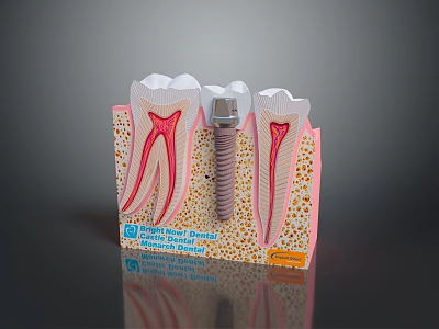 Dental Implant Medical Device With Tooth Structure And Bone Model 3d model