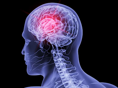 Modern human brain cancer 3d model Modern human brain cancer 3d model