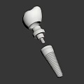 Dental Implant Components Featuring Tooth Crown and Metal Fixture for Tooth Restoration