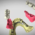 Detailed Dental Organ Prosthesis Models Featuring Crowns Bridges Abutments And Arch Structures