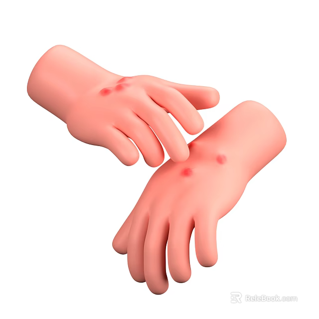 Detailed View Of Human Hands With Red Spots Indicating Skin Condition 3d model 