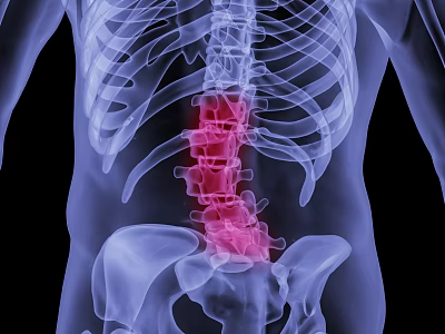 Modern Lumbar Disc Herniation Human Lumbar Disc Herniation 3d model