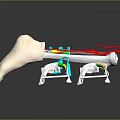 3D Bone Model With Implant Components Red Lines And Surgical Support Devices 3d model