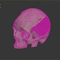 3D Printed Metal Mesh Cranial Implant Medical Device for Skull Reconstruction Surgery