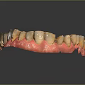 Dental Model Teeth With Pink Denture Base And Metal Component 3d model