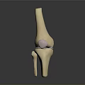 Knee Joint Medical Device 3D Model for Orthopedic Implant and Surgical Planning