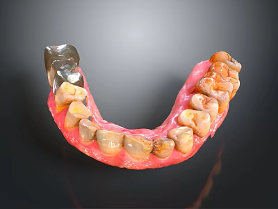 Dental Model Teeth With Pink Denture Base And Metal Component 3d model