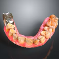 Dental Model Teeth With Pink Denture Base And Metal Component 3d model