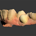 Dental Teeth Model With White Restored Teeth And Pink Gum Base For Dental Study