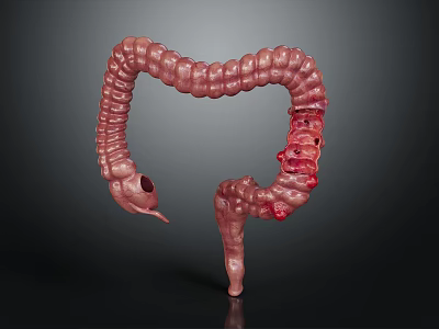 3D Medical Illustration of Human Intestinal Anatomy Model with Red Inflamed Areas 3d model