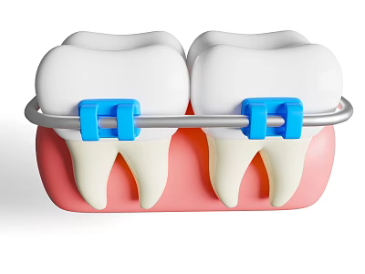 Art Installation Featuring Dental Braces With Blue Brackets And Metal Structure 3d model