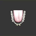 3D Model Of Oral Dental Medical Device Implant Abutment With Prosthetic Teeth