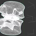 Medical Device Implant Between Lumbar Vertebrae for Orthopedic Spinal Fusion
