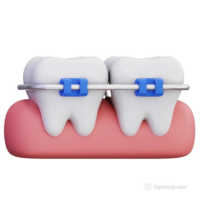 Decorative Ornament Combination Featuring Tooth Model Blue Braces And White Teeth 3d model