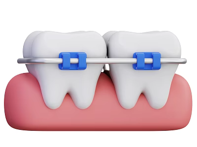 Decorative Ornament Combination Featuring Tooth Model Blue Braces And White Teeth 3d model