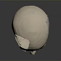 3D Printed Metal Mesh Cranial Implant Medical Device for Skull Reconstruction Surgery