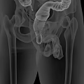 Medical Imaging Device For 3D Rendering Of Human Pelvis And Digestive System