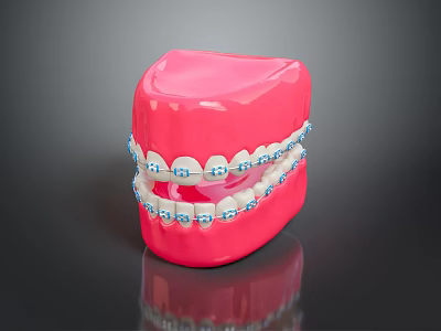 Pink Dental Model With Metal Braces And Blue Brackets On Teeth 3d model