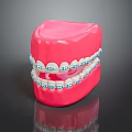Pink Dental Model With Metal Braces And Blue Brackets On Teeth