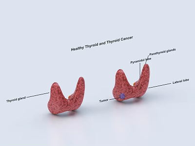 Healthy Thyroid vs Thyroid Cancer Glandular Structure With Tumor Parathyroid and Lobes 3d model
