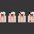 Dental Organ Structure Models Showing Healthy And Decayed Tooth Stages 3d model