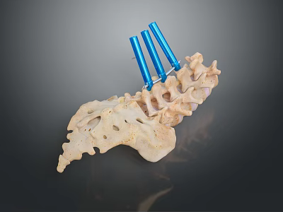 Animal Spine Skeleton With Blue Orthopedic Support Rods And Detailed Bone Structure 3d model