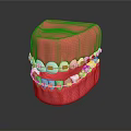 Pink Dental Model With Metal Braces And Blue Brackets On Teeth