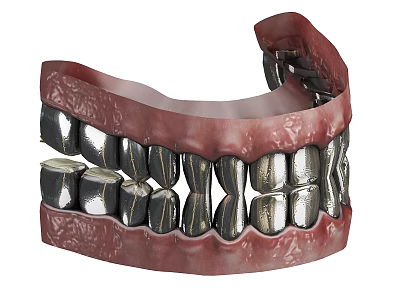 Dental Prosthesis Lower Jaw Model With Metal Framework And Artificial Teeth 3d model