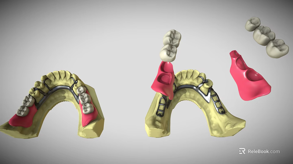 Detailed Dental Organ Prosthesis Models Featuring Crowns Bridges Abutments And Arch Structures 3d model 