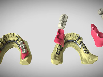 Detailed Dental Organ Prosthesis Models Featuring Crowns Bridges Abutments And Arch Structures 3d model