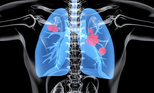 Modern lung disease 3d model