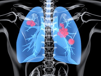 Modern lung disease 3d model