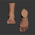 Man With Amputated Ankle Prosthetic Foot And Red Skin Areas On Feet