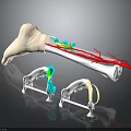 3D Bone Model With Implant Components Red Lines And Surgical Support Devices 3d model