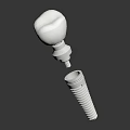 Dental Implant Components Featuring Tooth Crown and Metal Fixture for Tooth Restoration