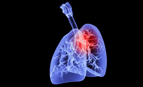 modern lung disease 3d model