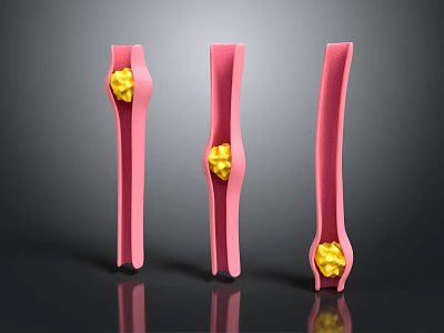 Anatomical Illustration of Nasal Passages With Three Yellow Blockage Structures 3d model