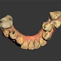Dental Teeth Model With White Restored Teeth And Pink Gum Base For Dental Study