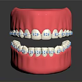 Pink Dental Model With Metal Braces And Blue Brackets On Teeth