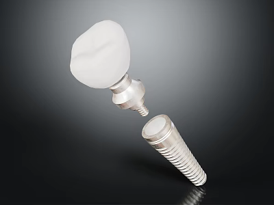 Dental Implant Components Featuring Tooth Crown and Metal Fixture for Tooth Restoration 3d model