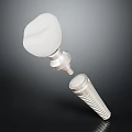 Dental Implant Components Featuring Tooth Crown and Metal Fixture for Tooth Restoration