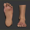 Man With Amputated Ankle Prosthetic Foot And Red Skin Areas On Feet