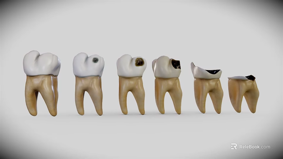Progression Stages of Tooth Decay From Healthy to Severely Damaged Teeth 3d model 