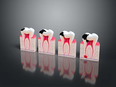 Dental Organ Structure Models Showing Healthy And Decayed Tooth Stages 3d model