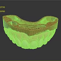Dental Teeth Model With Pink Gums White Teeth And Orange Orthodontic Tray