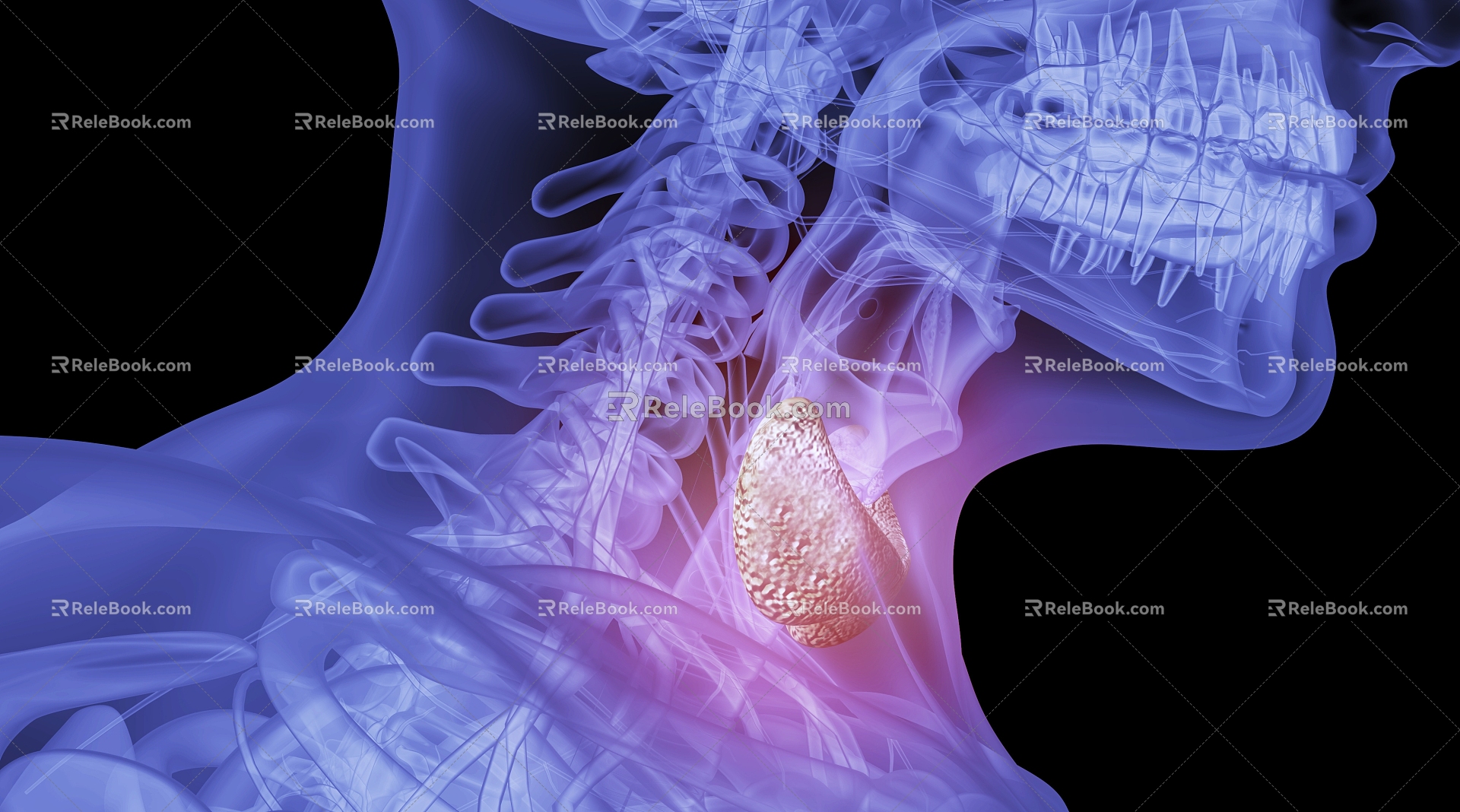 Human hyperthyroidism scene 3d model