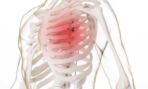 Modern Chest Rib Fractures 3d model