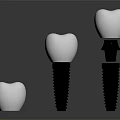 Dental Implant Medical Devices With Three White Crowns And Metal Screws