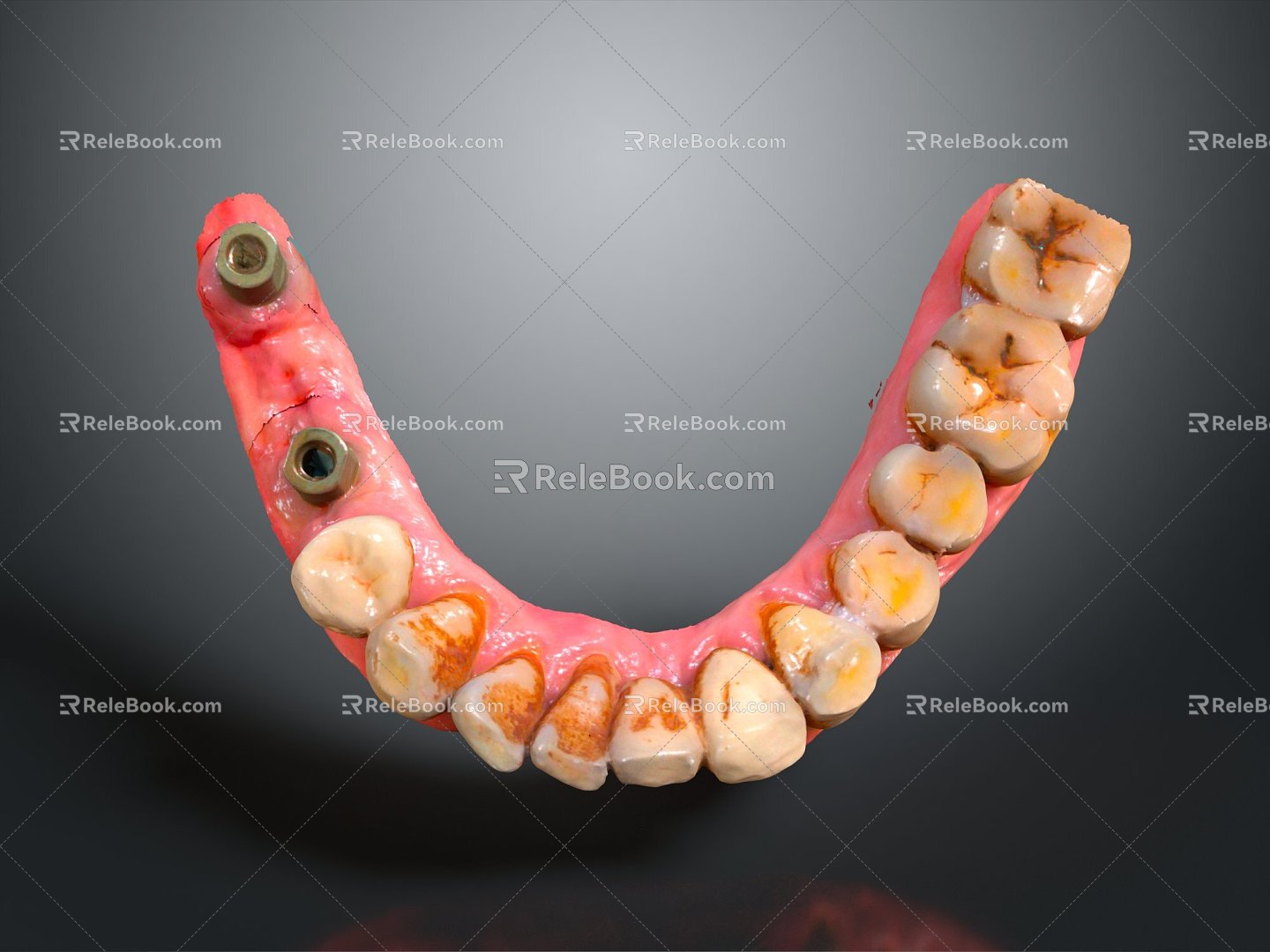 Dental Implant Modern Teeth 3d model